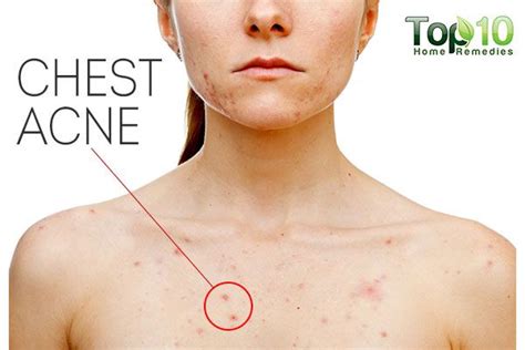 Chest Acne Chest Acne Cystic Acne Remedies Acne Treatment