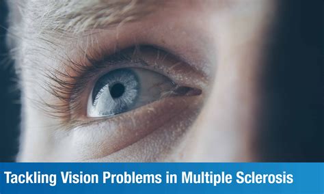 How To Deal With Vision Disturbances In Multiple Sclerosis Plexus