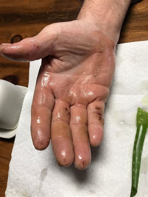 Skin Concerns People With Cracked Dry Split Winter Hands Any