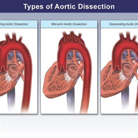 Anatomy Of The Carotid Artery Trial Exhibits Inc