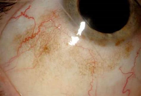 Conjunctival Primary Acquired Melanosis Wills Eye Hospital