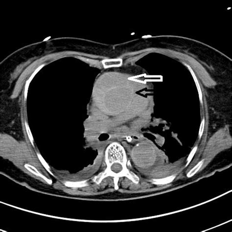 Non Contrast Chest Ct Showing False And True Lumens Of The Ascending