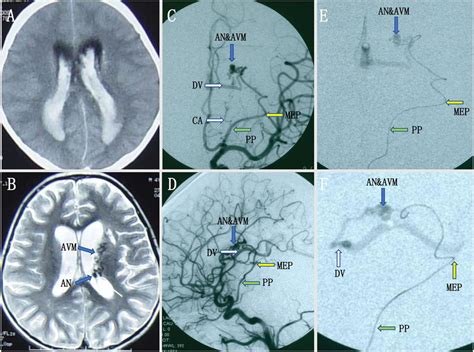 Ab Intraventricular Hemorrhage Was Noted On Initial Computed