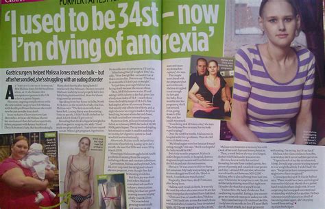 malissa once weighed 34 st now she s dying from anorexia sell your story uk the magazine