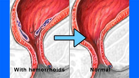 Heal your hemorrhoids provides natural treatment for hemorrhoids. How To Get Rid Of Internal Hemorrhoids Fast At Home ...