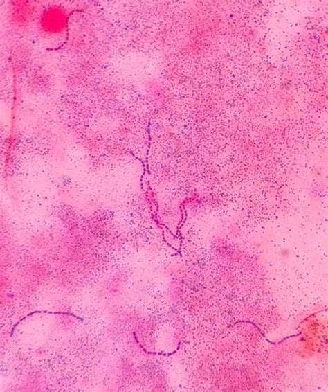 Gram Stain Of The Blood Culture Showing Gram Positive Cocci Grouped In