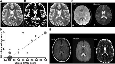 High Altitude Cerebral Edema Its Own Entity Or End Stage Acute