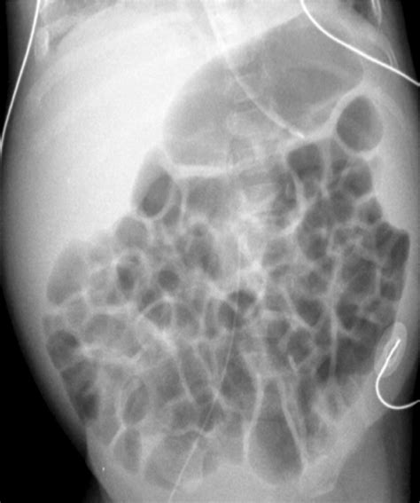 Figure 1 From Abnormal Neonatal Bowel Gas Patterns On Plain Radiography