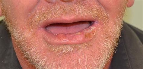 Squamous Cell Carcinoma Of The Lower Lip Affecting The Midline To Left