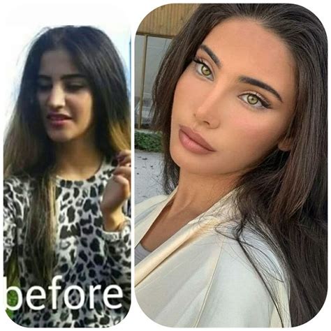 Negin Vaand Then And Now Facial Fillers Pretty Nose Nose Job