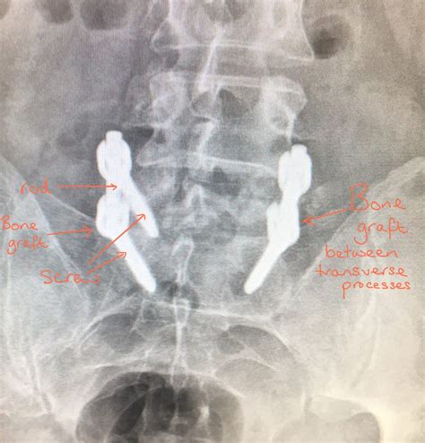 Lumbar Posterior Instrumented Fusion Spines Dorset