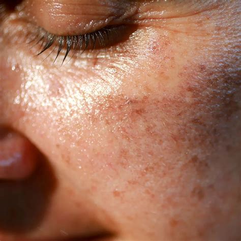 Sunspots On Skin Causes Treatment And Removal Ro