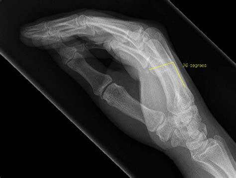 Hand And Wrist Fractures Undergraduate Diagnostic