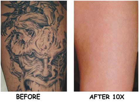 You may need to receive at least six to fifteen treatments to remove a professional tattoo. Laser Tattoo Removal | Laser Tattoo Removal Cost
