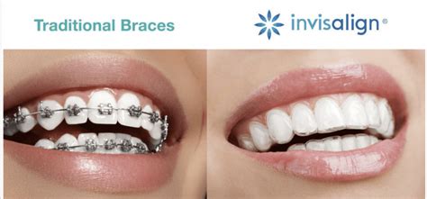 5 Differences Between Braces And Invisalign Bogota Dental Center Dentists
