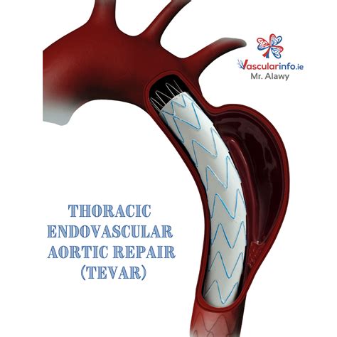 Thoracic Aortic Aneurysm Vascular Info