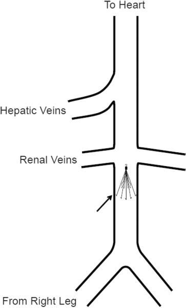 Inferior Vena Cava Filters Placement And Retrieval Journal Of
