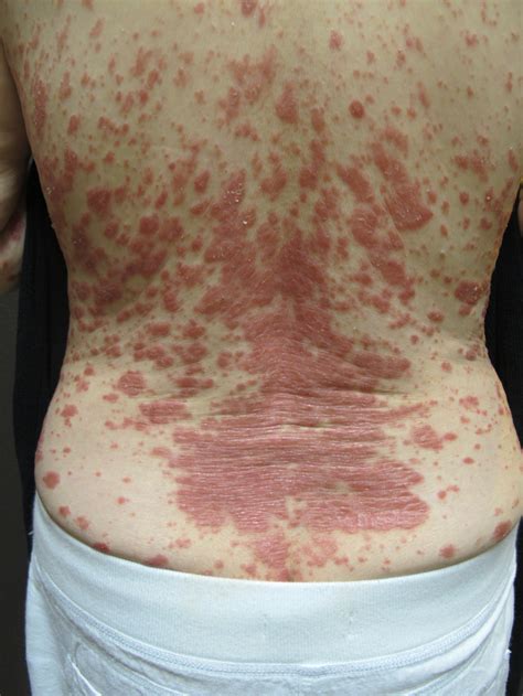 Acupuncture For Skin Conditions Eczema Psoriasis Urticaria Hives