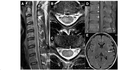 Spinal Cord T2 Weighted Mri Shows A Hyperintense Lesion Extending From