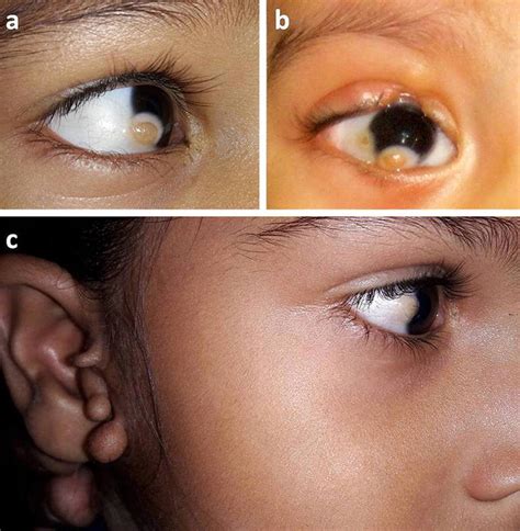A Right Eye Of A 3 Year Old Child Having Limbal Dermoid With No Other