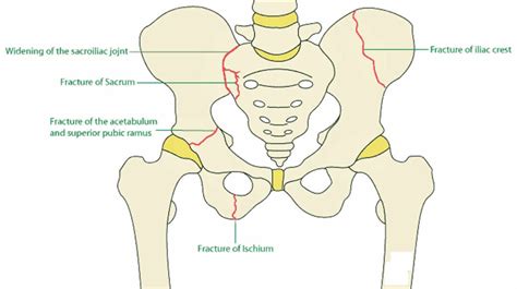 Pelvic Fracture Types Causes Signs Symptoms Diagnosis And Treatment