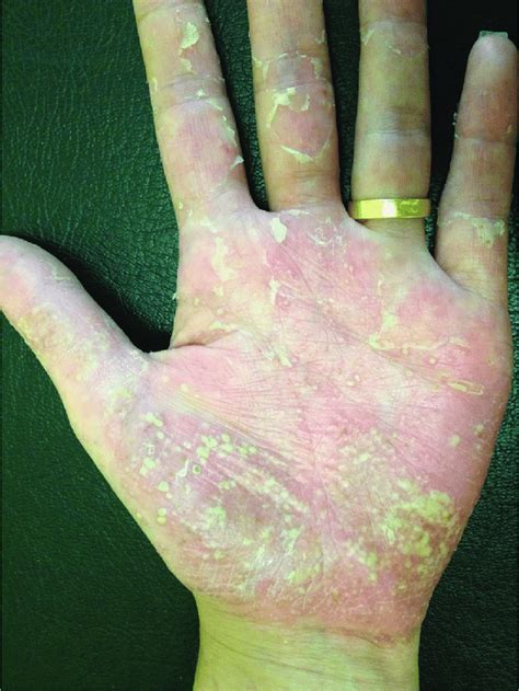 Erythema Multiple Pustules And Scaling In The Palmar Surface Of The