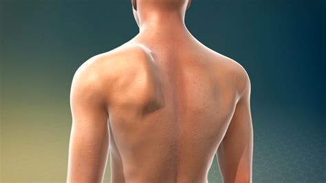 How To Fix A Winged Scapula Tom Morrison