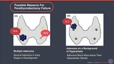 Possible Reasons For Parathyroidectomy Failure Hyperparathyroidism