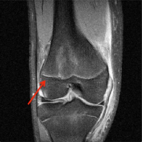 Mri Showing Increased Fluid Density Around The Lateral Distal Femoral Download Scientific