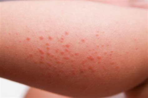 Red Patches On Skin Causes Symptoms And Treatment