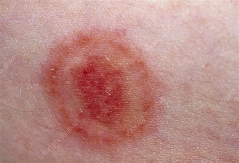 Ringworm Infection On The Arm Of A Sheepworker Stock Image M270