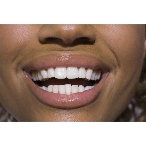 Do It Yourself Mouthpiece Molding For Teeth Whitening Our Everyday Life