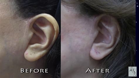 Ear Lobe Reduction Surgery Youtube