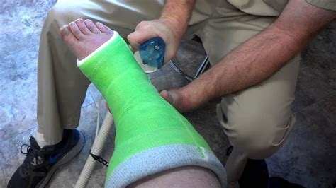 Cast Removal After Broken Ankle Slipped On Ice Taking Pic In Montana
