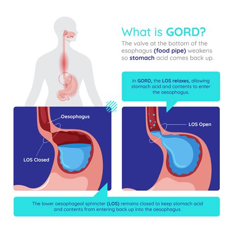 Bowel Cancer Symptoms Infographic Digestive Health Uk