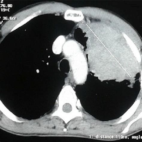 Ct Scan Of The Chest Showing A Tumor Mass In The Left Upper Lobe Which