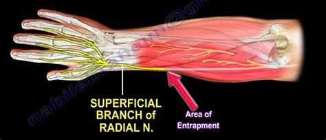 Wartenberg’s Syndrome The Superficial Branch Of The Radial… By Nabil Ebraheim Medium