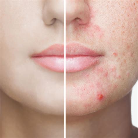 6 Skin Conditions That Look Like Acne But Isnt Acne Dr Terry Loong
