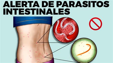 8 señales silenciosas de que tienes parásitos intestinales YouTube