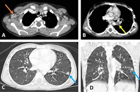 An Unusual Cause Of Finger Swelling Bmj Case Reports