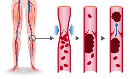 Thrombosis abgeleitet) ist eine gefäßerkrankung oder störung des kreislaufsystems, bei der sich (intravital) ein blutgerinnsel (thrombus, blutpropf) in einem blutgefäß bildet. Thrombose - Ursachen, Beschwerden & Therapie | Gesundpedia.de