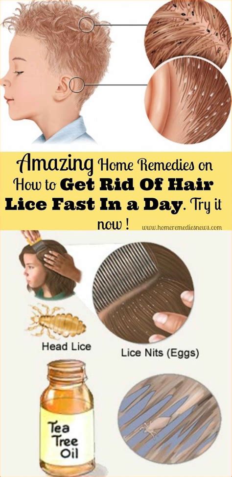 Apply this oil solution to your scalp and hair thoroughly. How To Get Rid Of Head Lice In One Day | Lice home ...