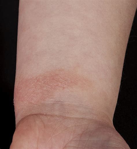 Management Of Atopic Hand Dermatitis Dermatologic Clinics
