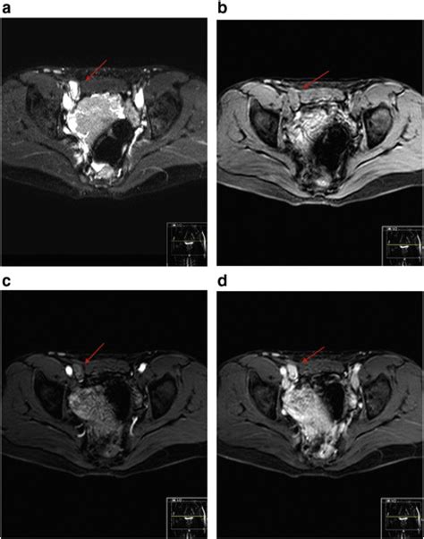 Imaging Characteristics Of Androgen Insensitivity Syndrome Clinical Imaging