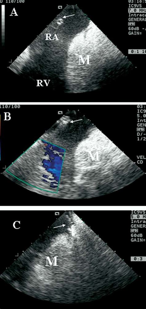 Intracardiac Echocardiographic Views Showing Right Atrium Ra Right