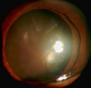 Start studying anatomical terms 2 of 2. Black Cataract - EyeWiki