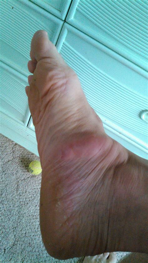 If this lump is on the outside of your foot, it's not a bunion. foot bump | Windsurfing Forums, page 1