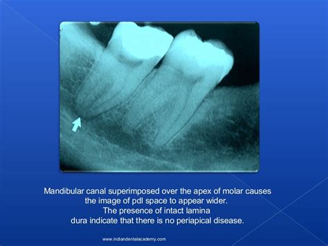 Lamina Dura Oral Surgery Courses