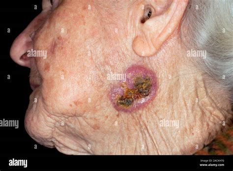 Basal Cell Carcinoma Skin Cancer On The Cheek Of The Face In An 84