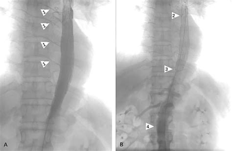 Angiography Was Performed Immediately After Stent Implantation To